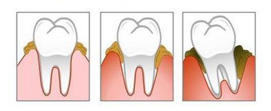 电动牙刷如何使用?电动牙刷的正确使用方法图解 业界杂谈 第2张 电动牙刷如何使用?电动牙刷的正确使用方法图解 业界杂谈 第2张